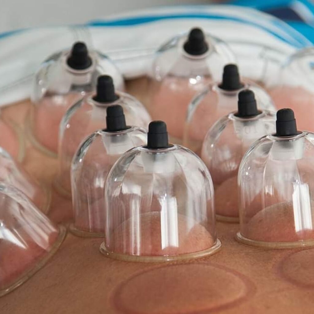 cupping therapy before and after
